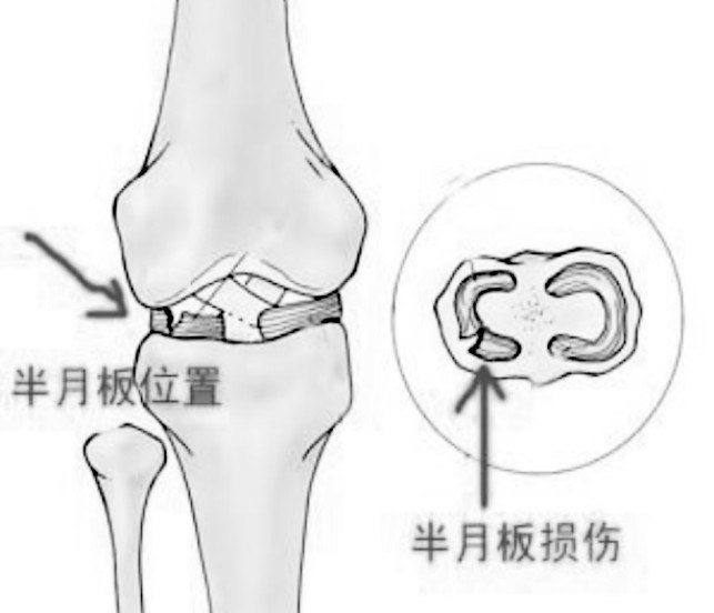 半月板治療新進(jìn)展揭秘，巷弄深處的醫(yī)學(xué)奧秘探索